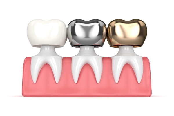 Types of Dental Crown Material 